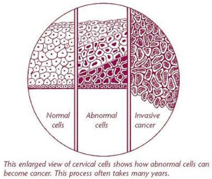 Are abnormal cells in cervix common?