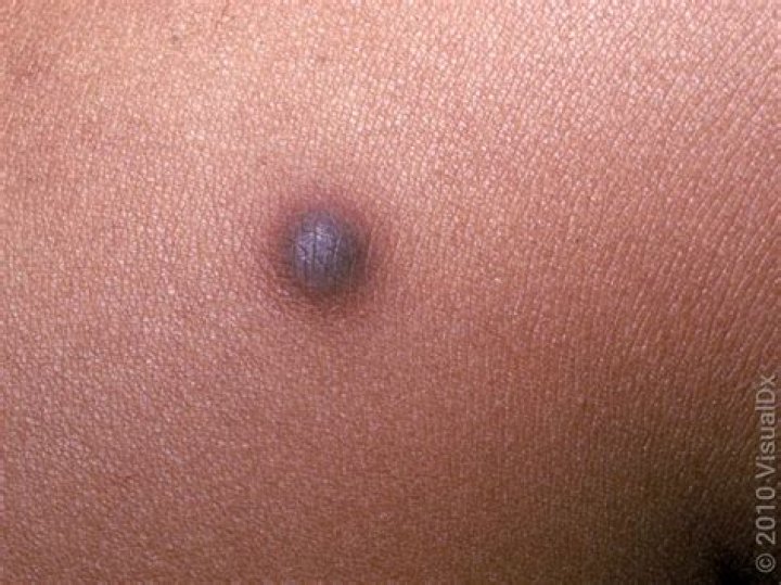 Are dermatofibromas scaly?