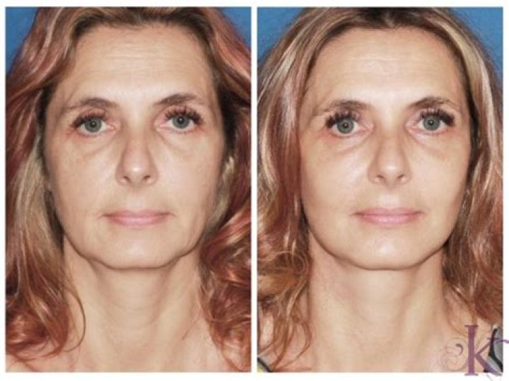 Are mini facelifts worth it?