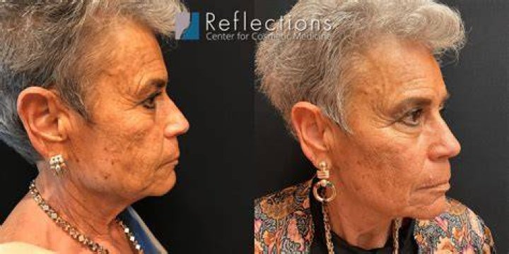 Can a 75 year old woman get Botox?
