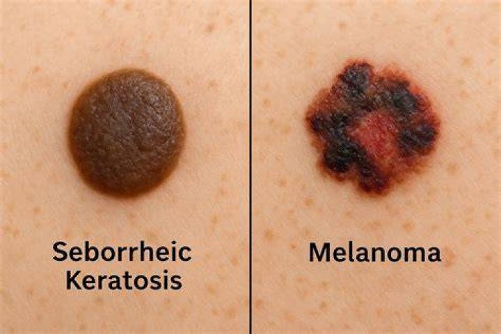 Can a seborrheic keratosis bleed?