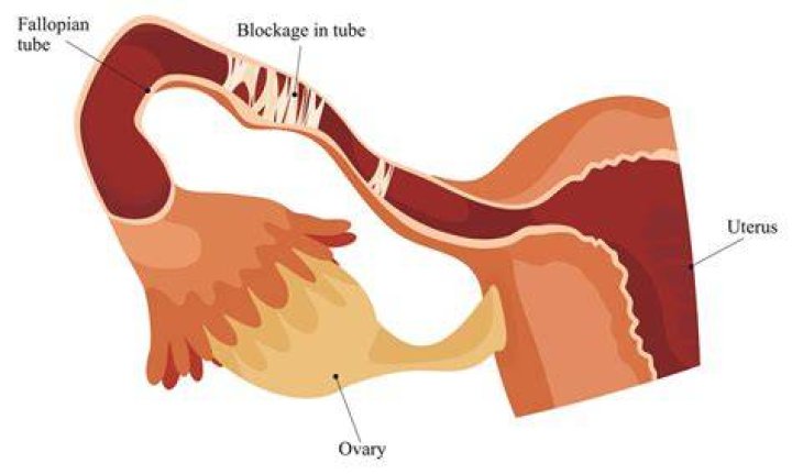 Can a woman with blocked fallopian tubes have periods?