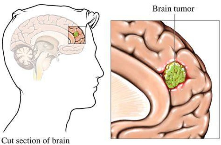 Can an optometrist tell if you have a brain tumor?