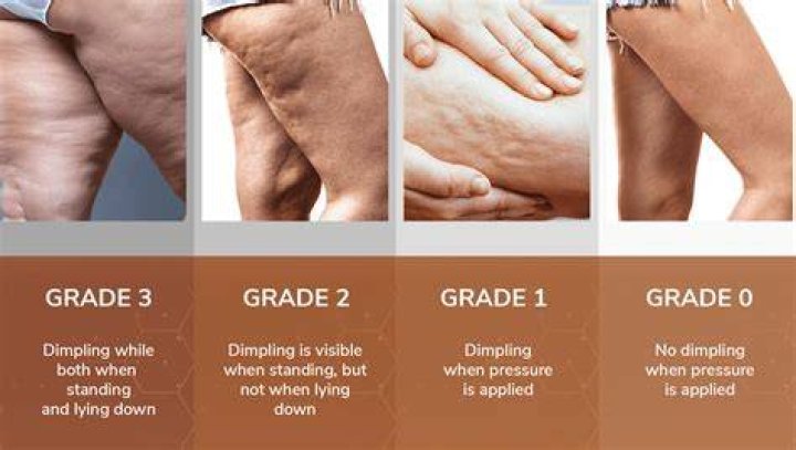 Can anything improve cellulite?