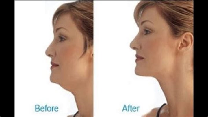 Can chewing gum get rid of double chin?