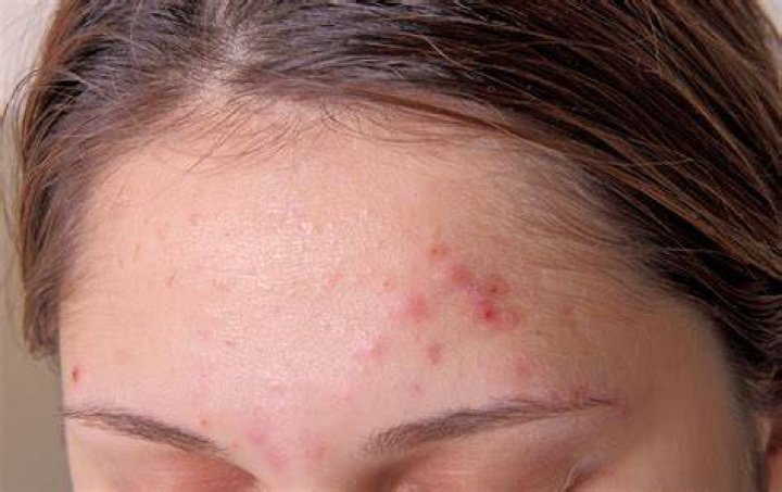 Can dandruff spread to face?