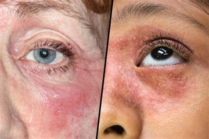 Can eczema flare for no reason?