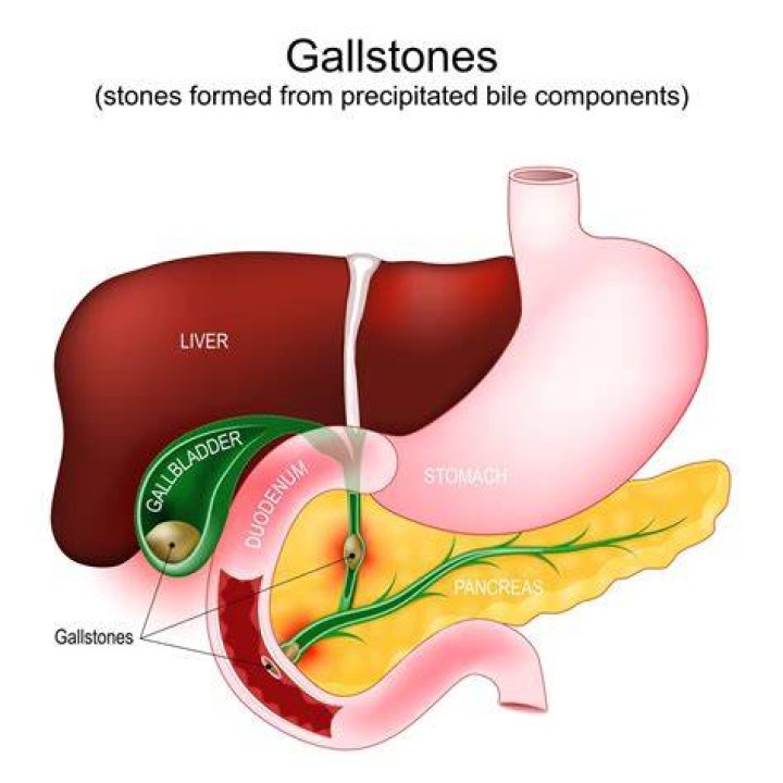 Can gallstones lead to death?