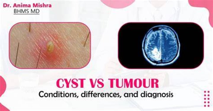 Can MRI differentiate between cyst and tumor?