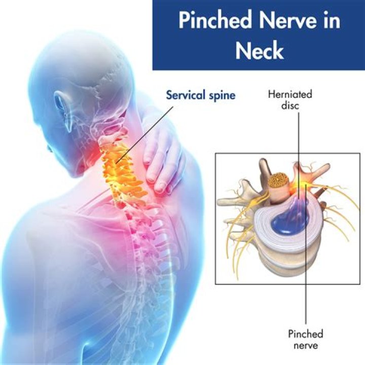 Can pinched nerve be cured?