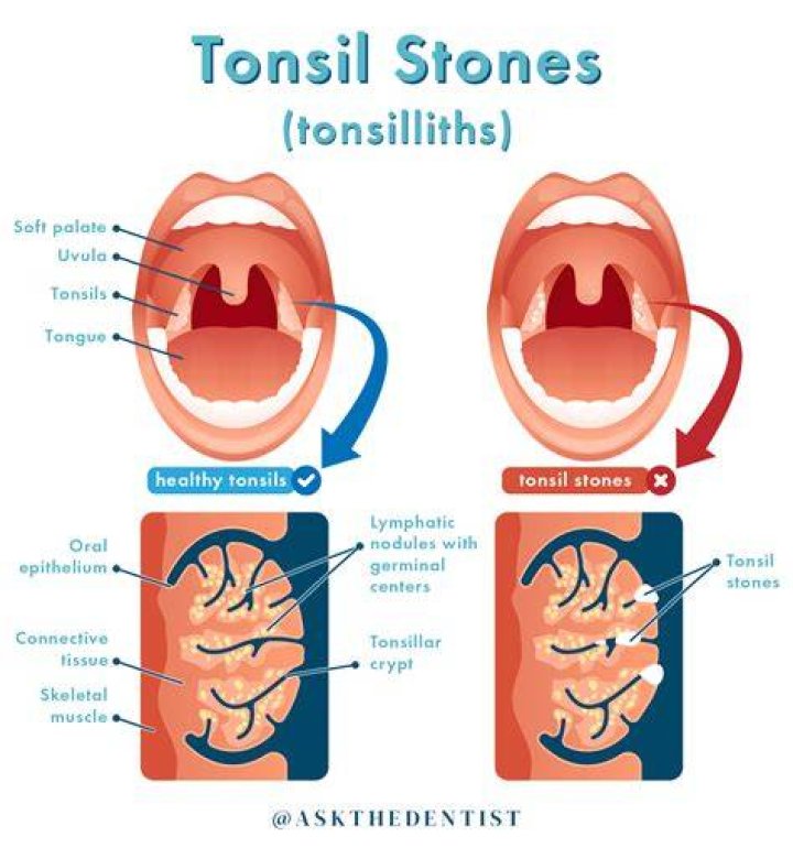 Can tonsil stones cause fatigue?