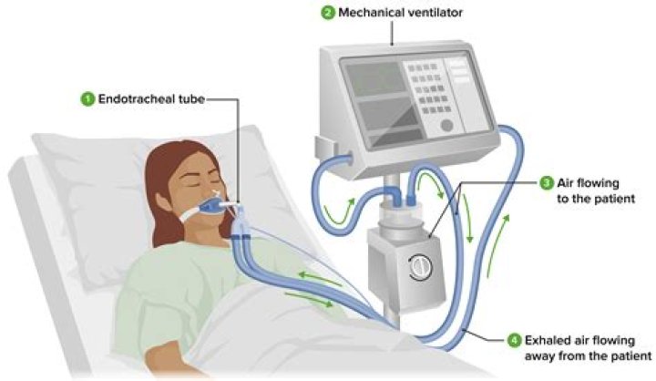 Can you be conscious on a ventilator?
