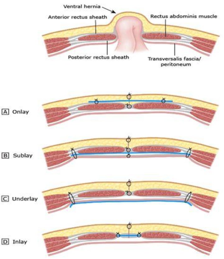 Can you fix an umbilical hernia without surgery?