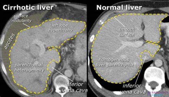 Can you live a normal life with cirrhosis?