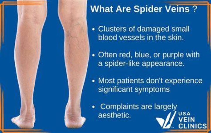 Can you massage spider veins away?