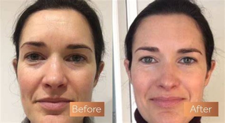 Can you reverse collagen loss?