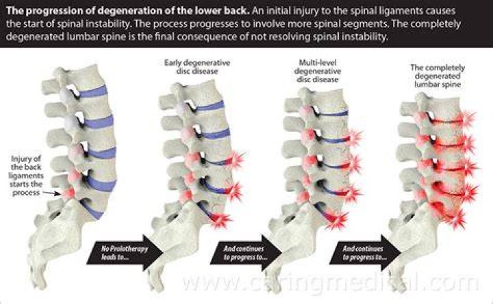 Can you reverse disc degeneration?