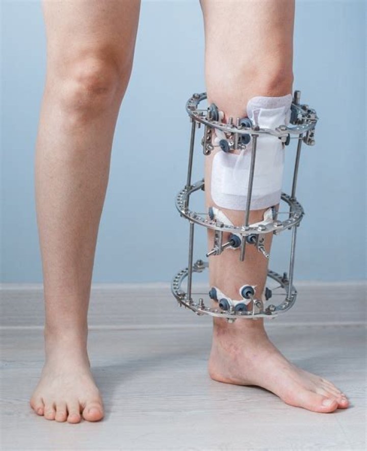 Can you walk with an Ilizarov frame?