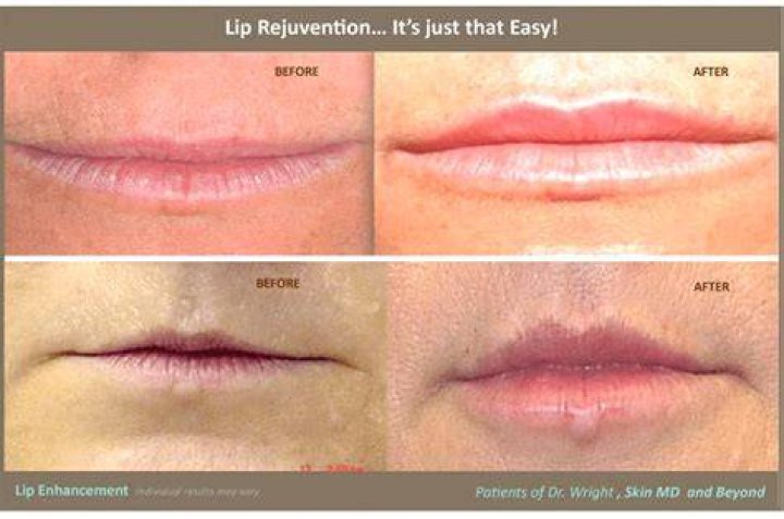 Can your lips get smaller naturally?