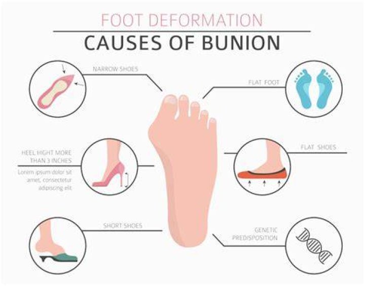 Do bunions get worse if not treated?