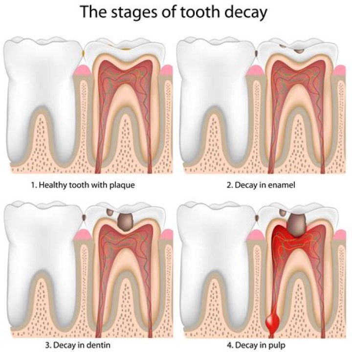 Do cavities weaken teeth?