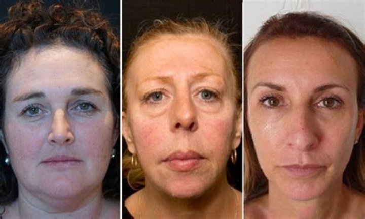 Do fillers ruin your face over time?