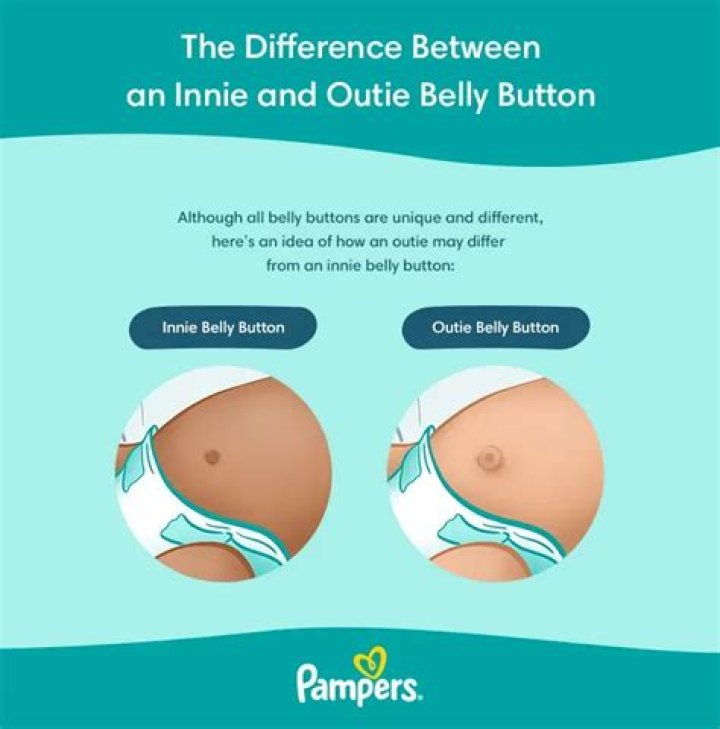 Do outie belly buttons go away?