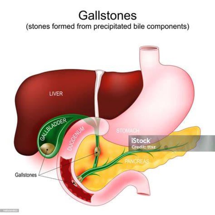 Do they take out appendix with gallbladder?