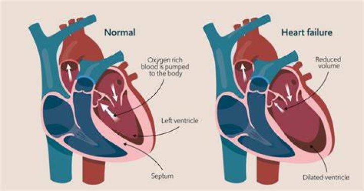 Do you get a cough with congestive heart failure?