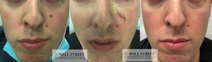 Does a mole removal leave a scar?