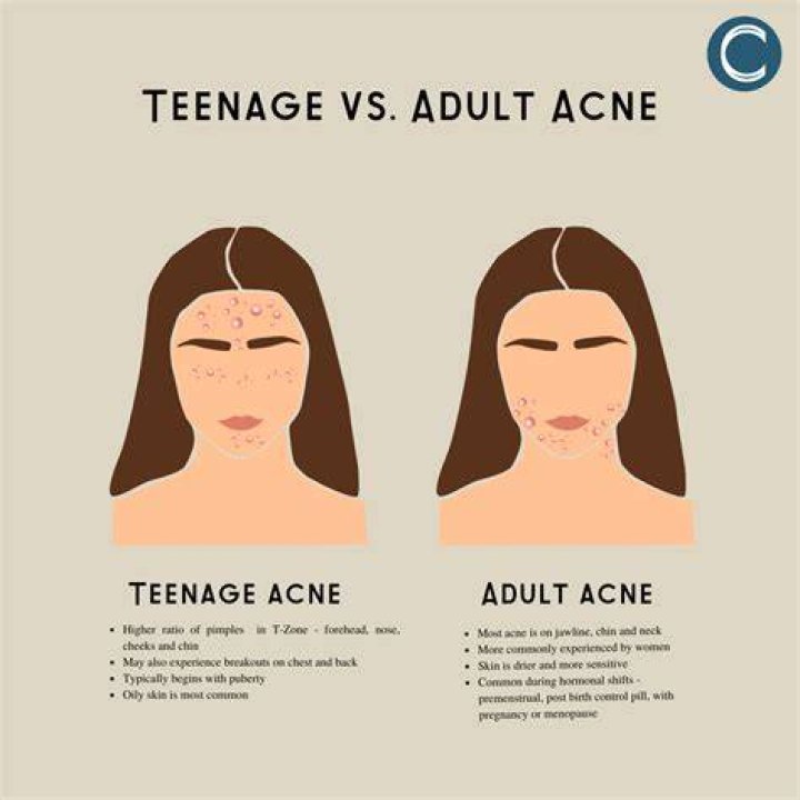 Does acne go away at 17?