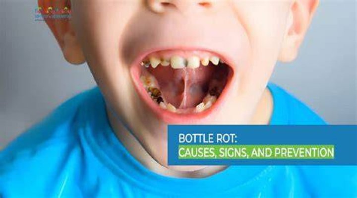 Does beer rot your teeth?
