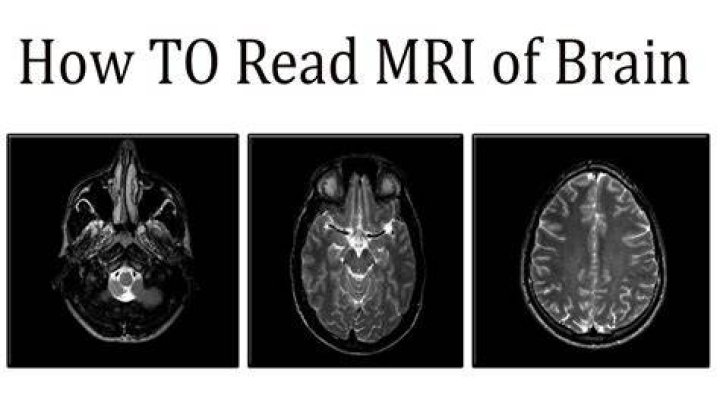 Does brain MRI show eye problems?