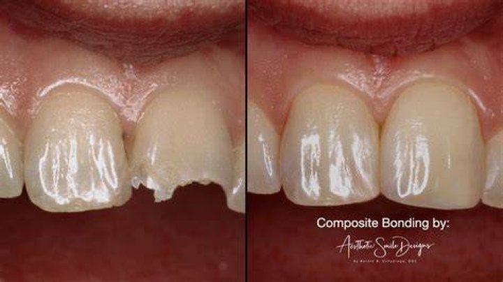 Does composite bonding darken?