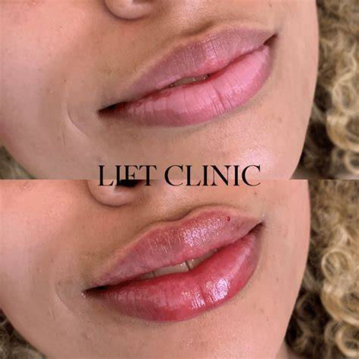 Does hyaluronic acid make your lips bigger?