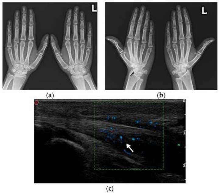 Does lupus show on xray?