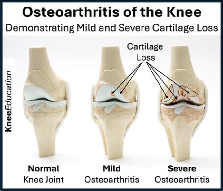 Does osteoarthritis turn into rheumatoid arthritis?