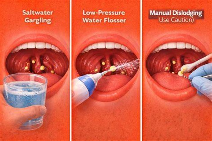 Does removing your tonsils get rid of tonsil stones?