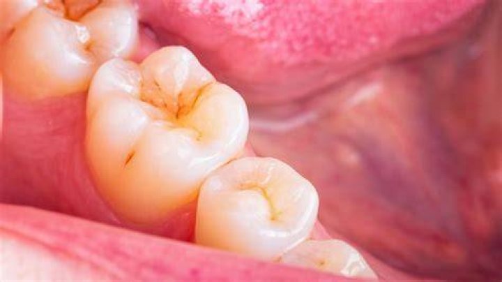 Does salt cause cavities?