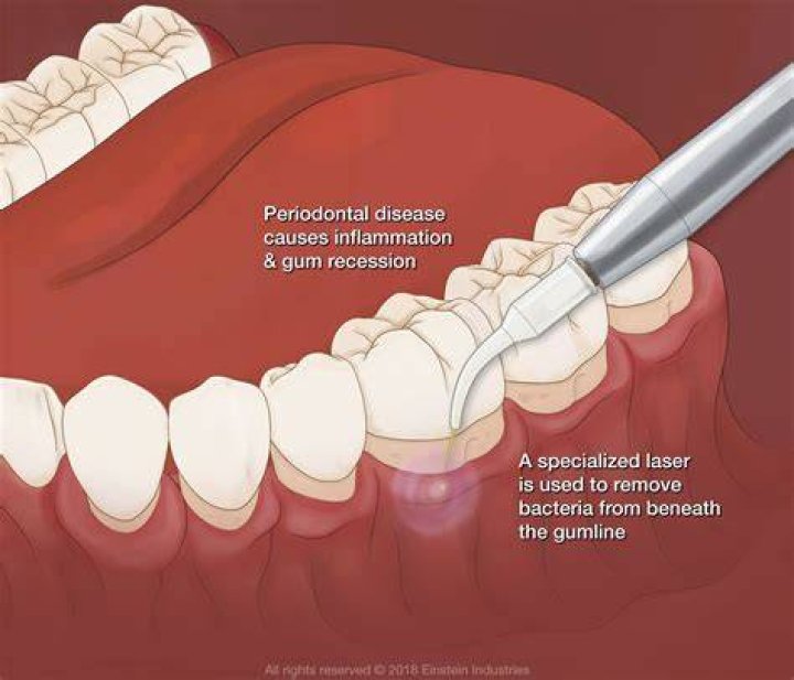 Does surgery cure periodontal disease?