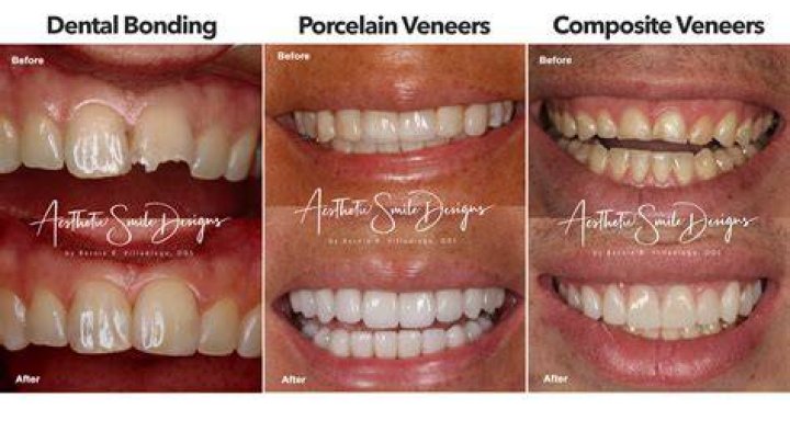 Does turmeric stain porcelain veneers?