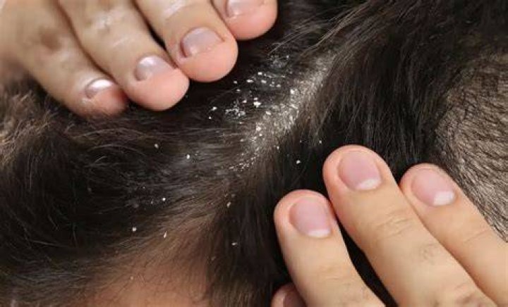 Does wet hair cause dandruff?