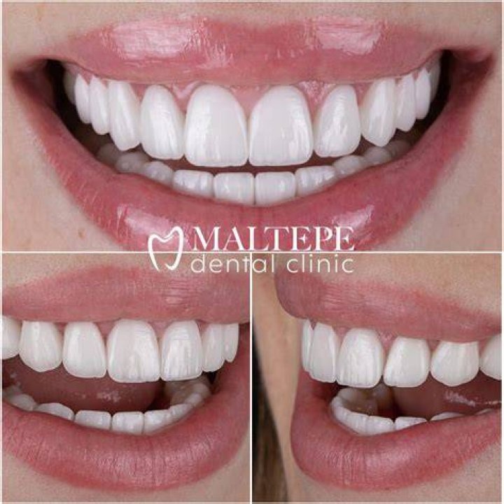 How attractive are straight teeth?