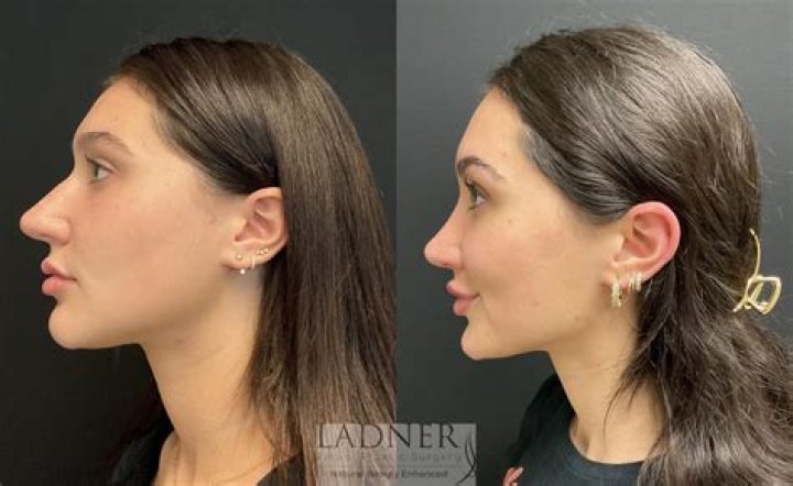 How can I see what I would look like with a nose job?