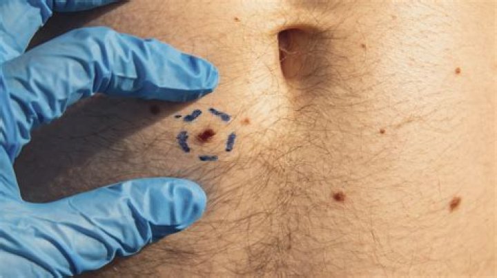 How can you tell if a spot is cancerous?