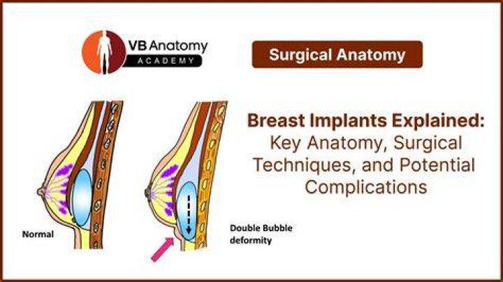 How can you tell someone has breast implants?