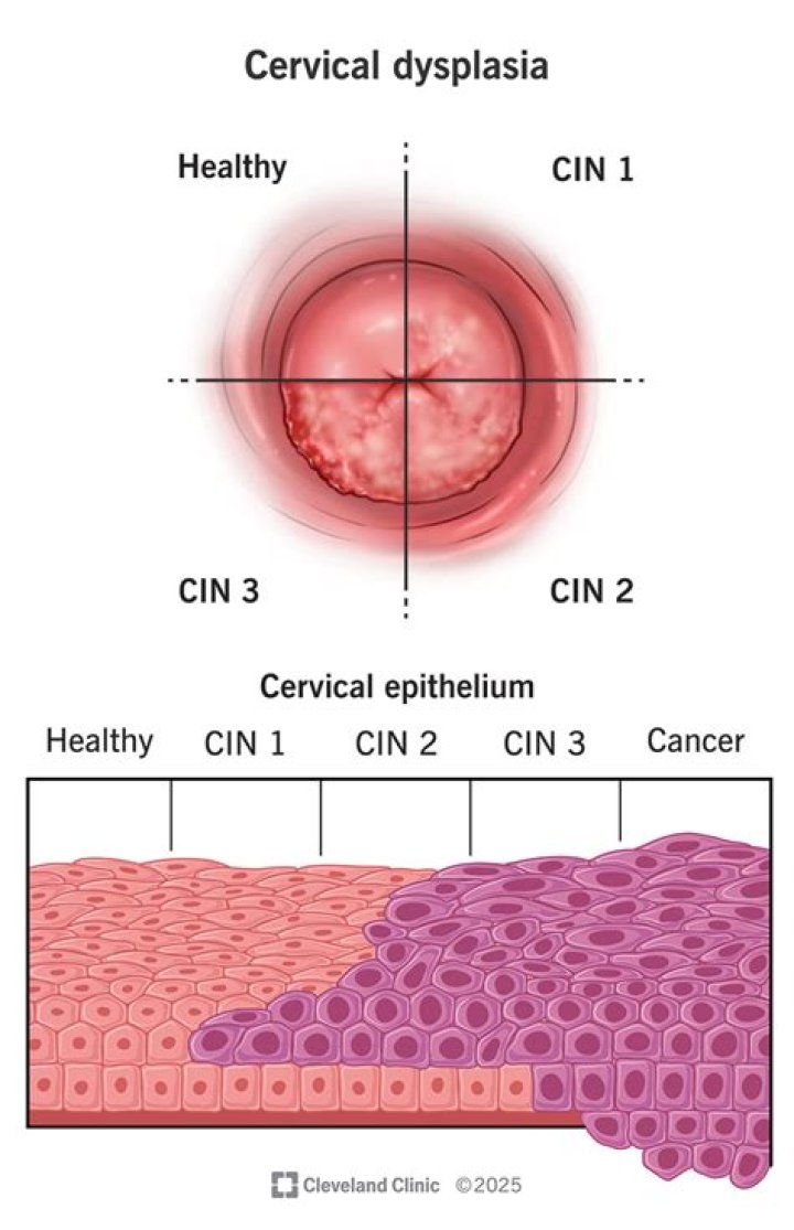 How do you get abnormal cells on cervix?