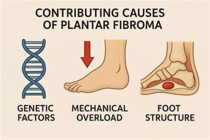 How do you get rid of a plantar fibroma naturally?