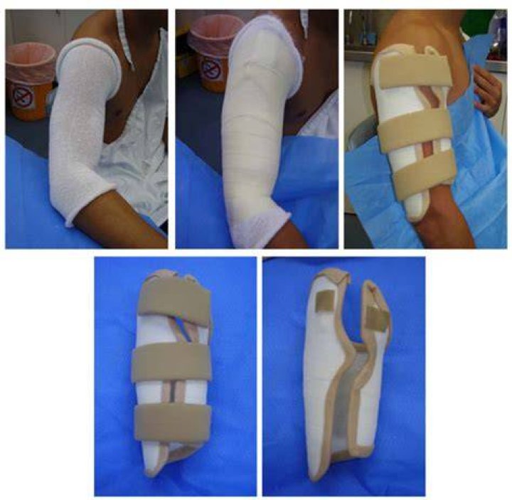 How do you get the May cast brace?