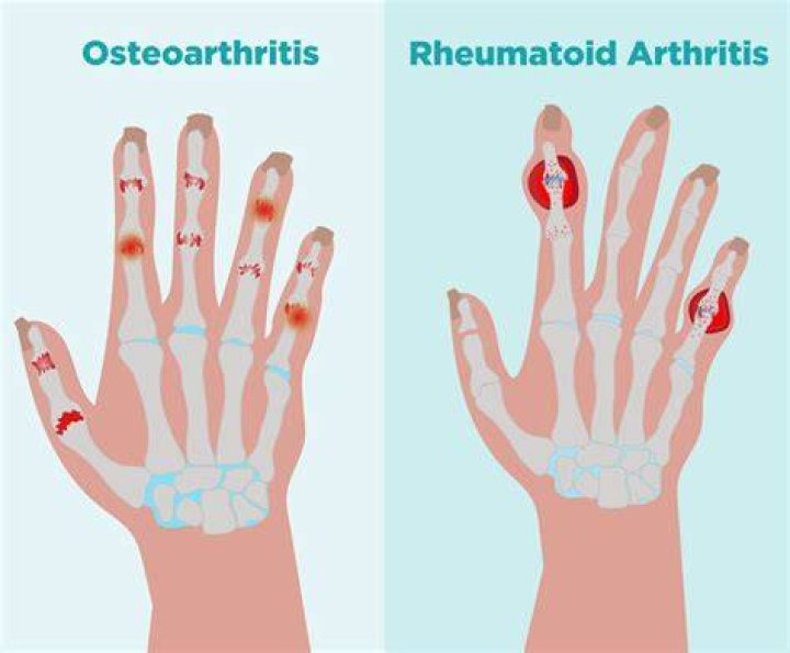 How do you know if you've got rheumatoid arthritis?